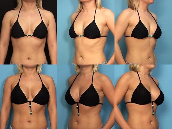 Before & After Breast Augmentation Case 123 View #2 View in Panama City & Pensacola, Florida
