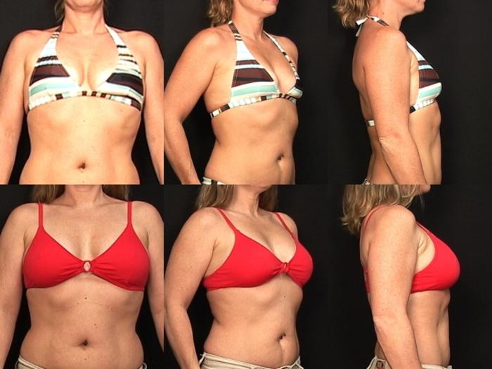 Before & After Breast Augmentation Case 124 View #2 View in Panama City & Pensacola, Florida