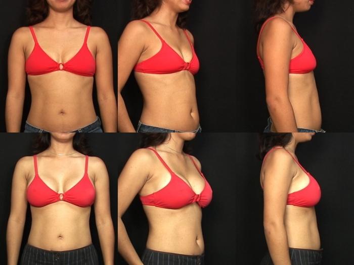 Before & After Breast Augmentation Case 126 View #2 View in Panama City & Pensacola, Florida