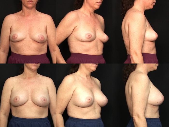 Before & After Breast Augmentation Case 127 View #1 View in Panama City & Pensacola, Florida