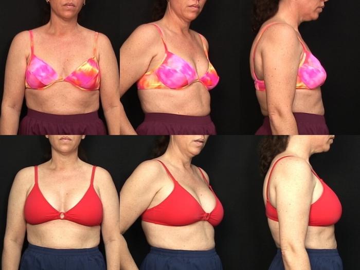 Before & After Breast Augmentation Case 127 View #2 View in Panama City & Pensacola, Florida