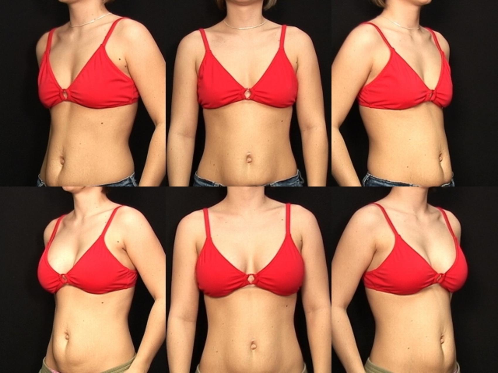 Before & After Breast Augmentation Case 128 View #2 View in Destin & Pensacola, Florida