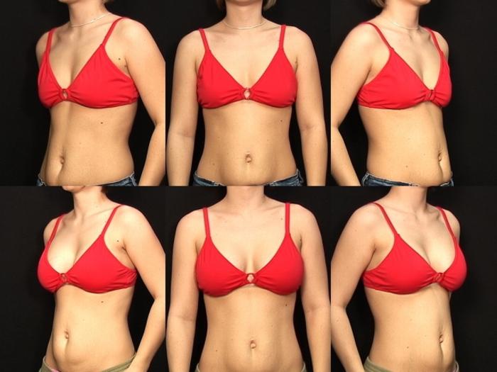 Before & After Breast Augmentation Case 128 View #2 View in Panama City & Pensacola, Florida