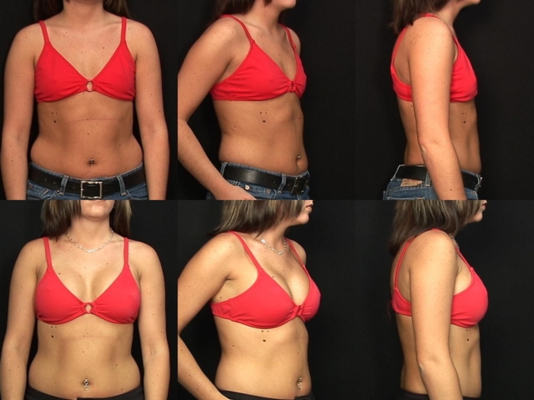 Before & After Breast Augmentation Case 129 View #2 View in Destin & Pensacola, Florida