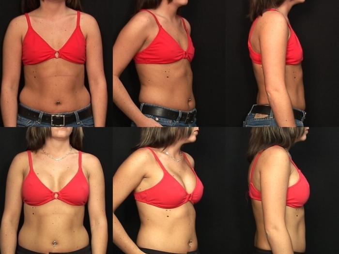 Before & After Breast Augmentation Case 129 View #2 View in Panama City & Pensacola, Florida