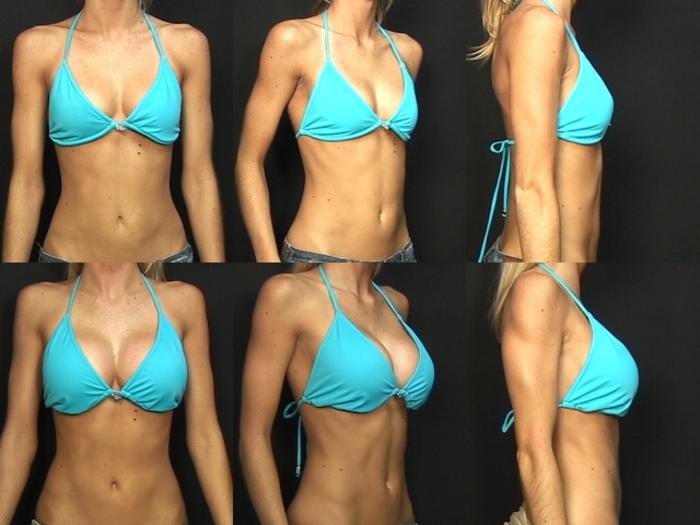 Before & After Breast Augmentation Case 131 View #2 View in Panama City & Pensacola, Florida