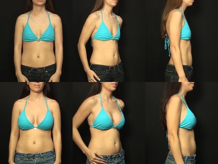 Before & After Breast Augmentation Case 132 View #2 View in Panama City & Pensacola, Florida