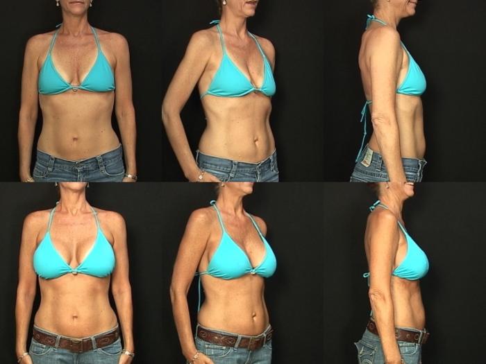 Before & After Breast Augmentation Case 137 View #2 View in Panama City & Pensacola, Florida