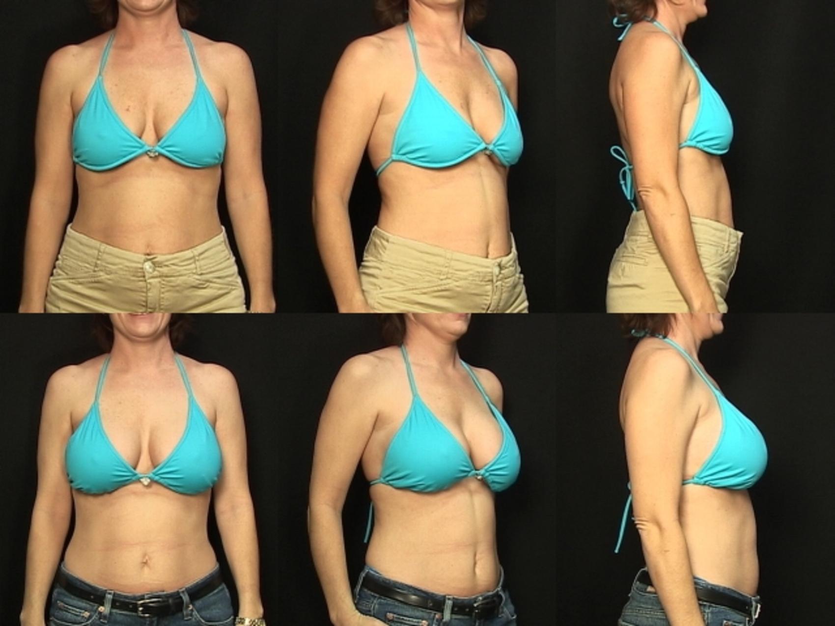 Before & After Breast Augmentation Case 138 View #2 View in Destin & Pensacola, Florida