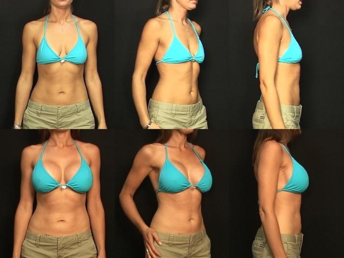 Before & After Breast Augmentation Case 139 View #2 View in Panama City & Pensacola, Florida