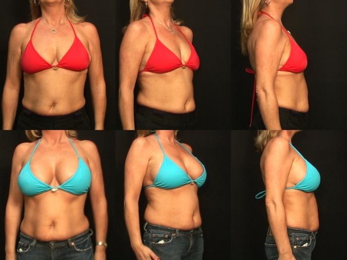 Before & After Breast Augmentation Case 140 View #2 View in Panama City & Pensacola, Florida