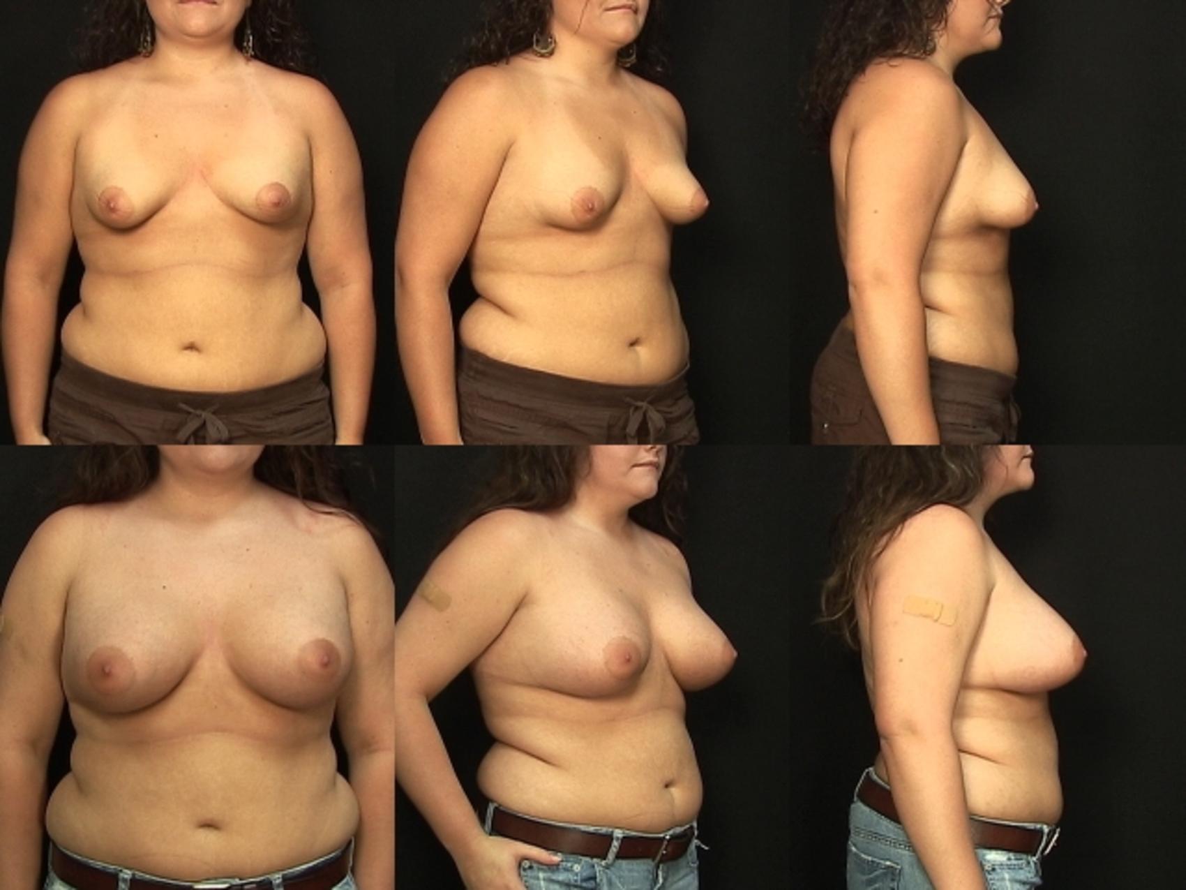 Before & After Breast Augmentation Case 141 View #1 View in Panama City & Pensacola, Florida