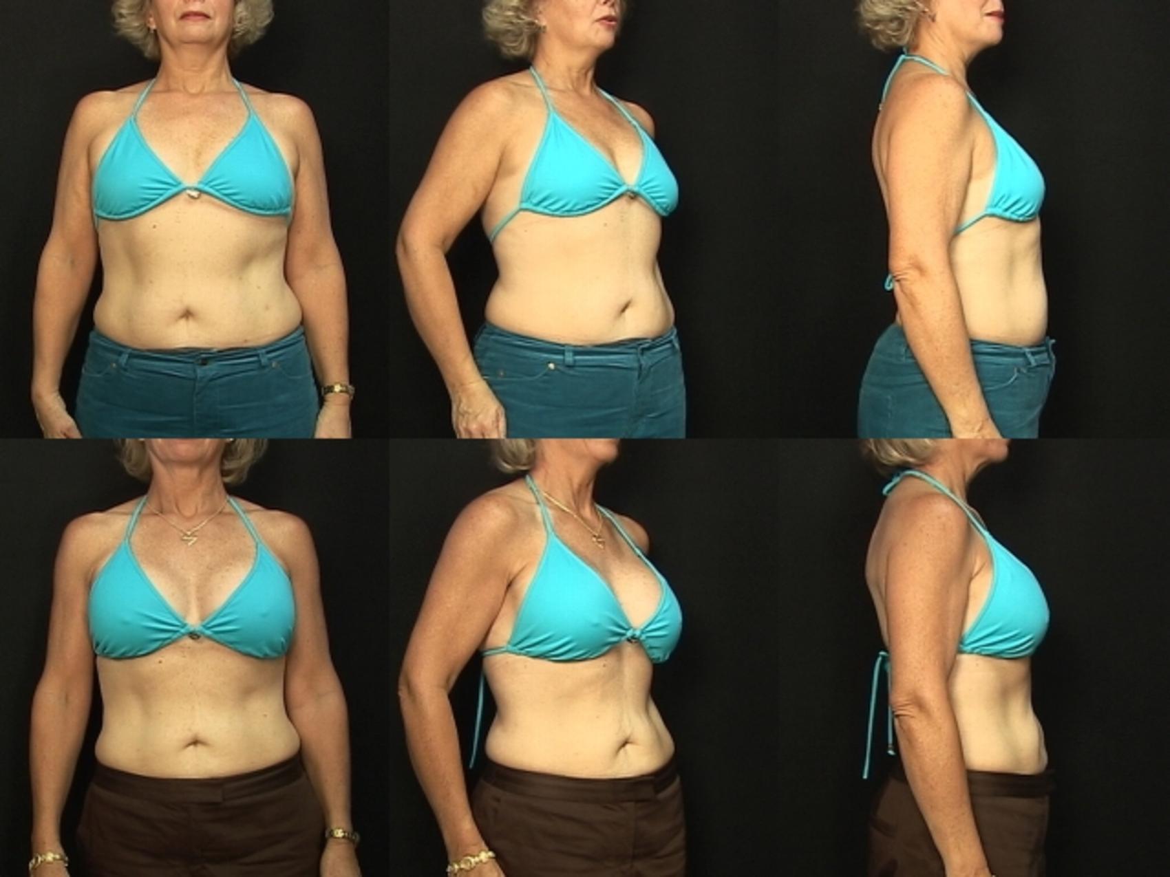 Before & After Breast Augmentation Case 142 View #2 View in Destin & Pensacola, Florida