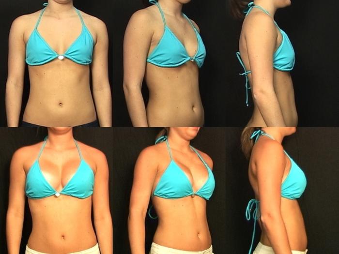 Before & After Breast Augmentation Case 275 View #2 View in Panama City & Pensacola, Florida