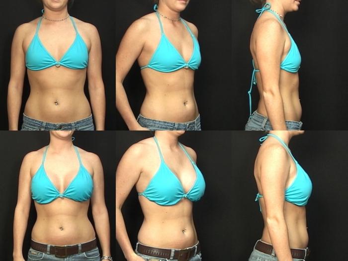 Before & After Breast Augmentation Case 276 View #2 View in Panama City & Pensacola, Florida
