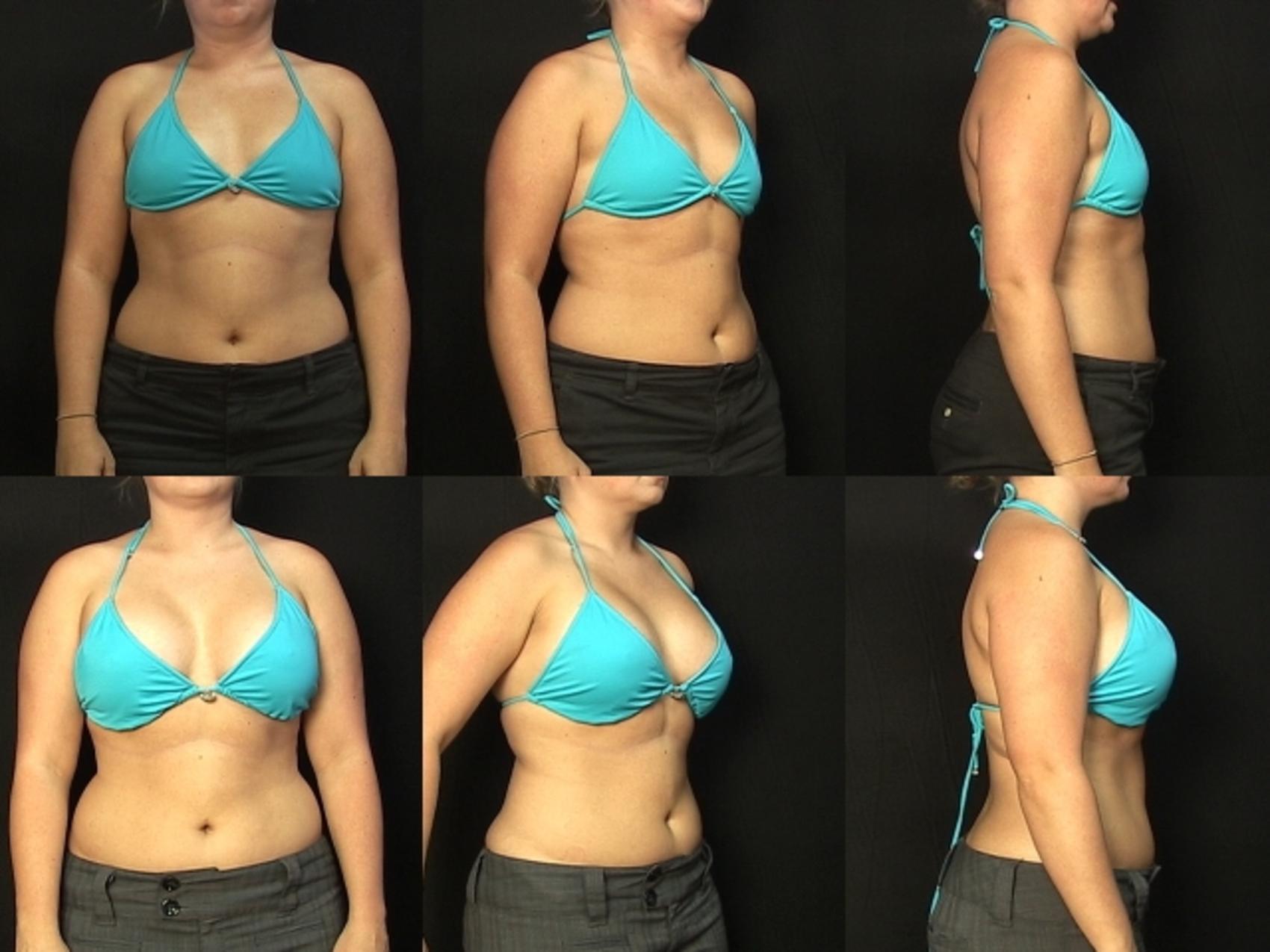 Before & After Breast Augmentation Case 281 View #2 View in Destin & Pensacola, Florida