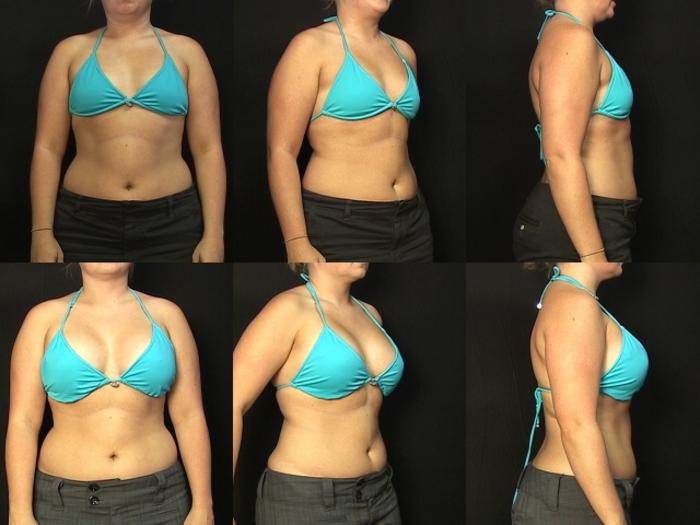 Before & After Breast Augmentation Case 281 View #2 View in Panama City & Pensacola, Florida