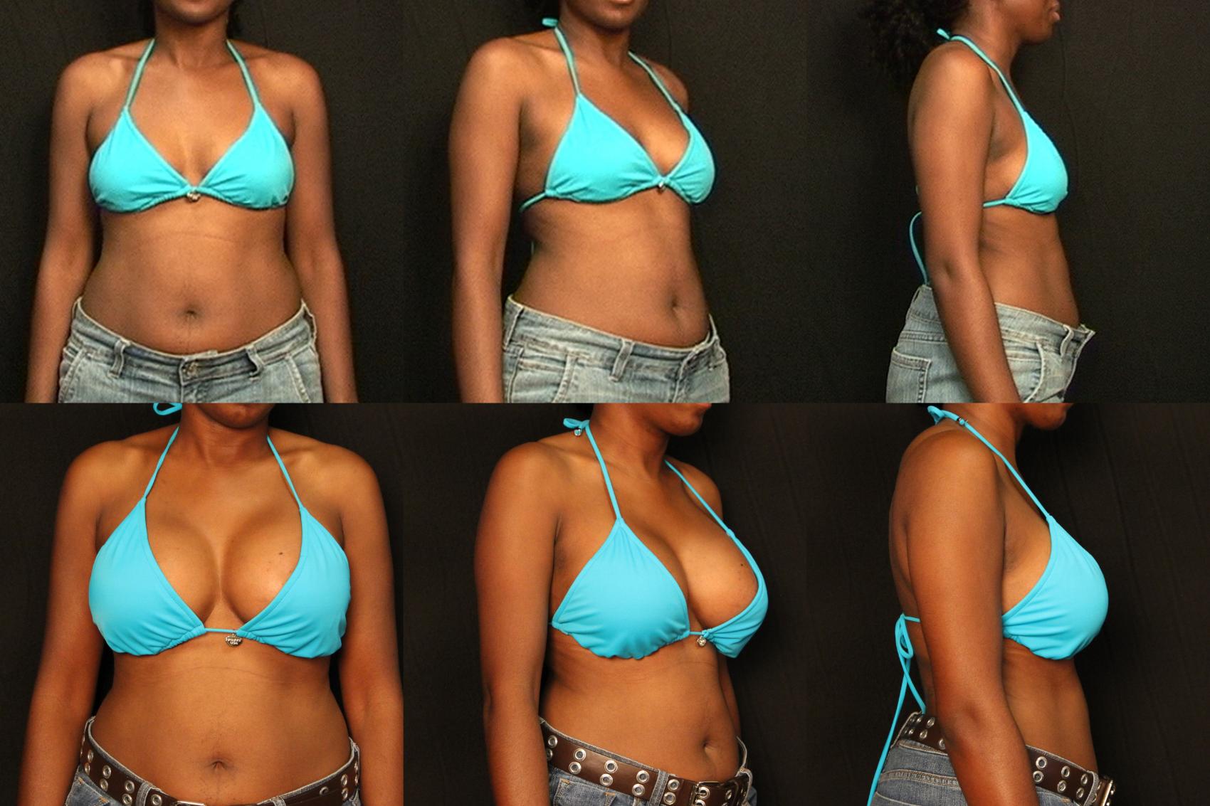 Before & After Breast Augmentation Case 293 View #2 View in Destin & Pensacola, Florida
