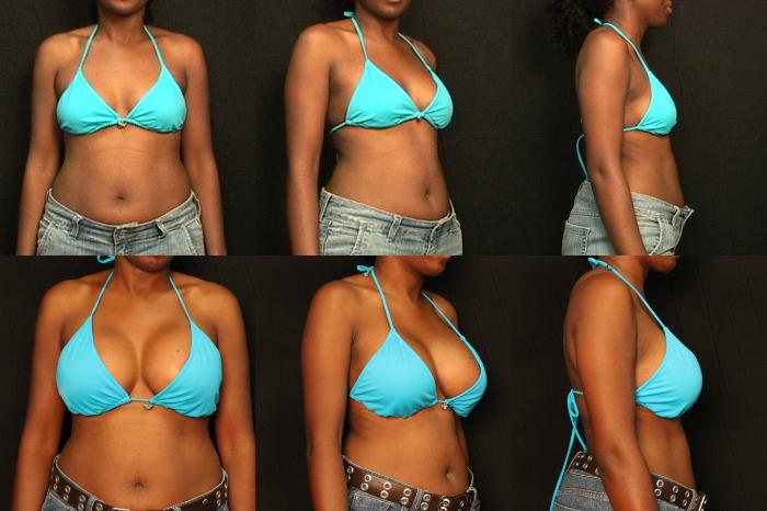 Before & After Breast Augmentation Case 293 View #2 View in Panama City & Pensacola, Florida
