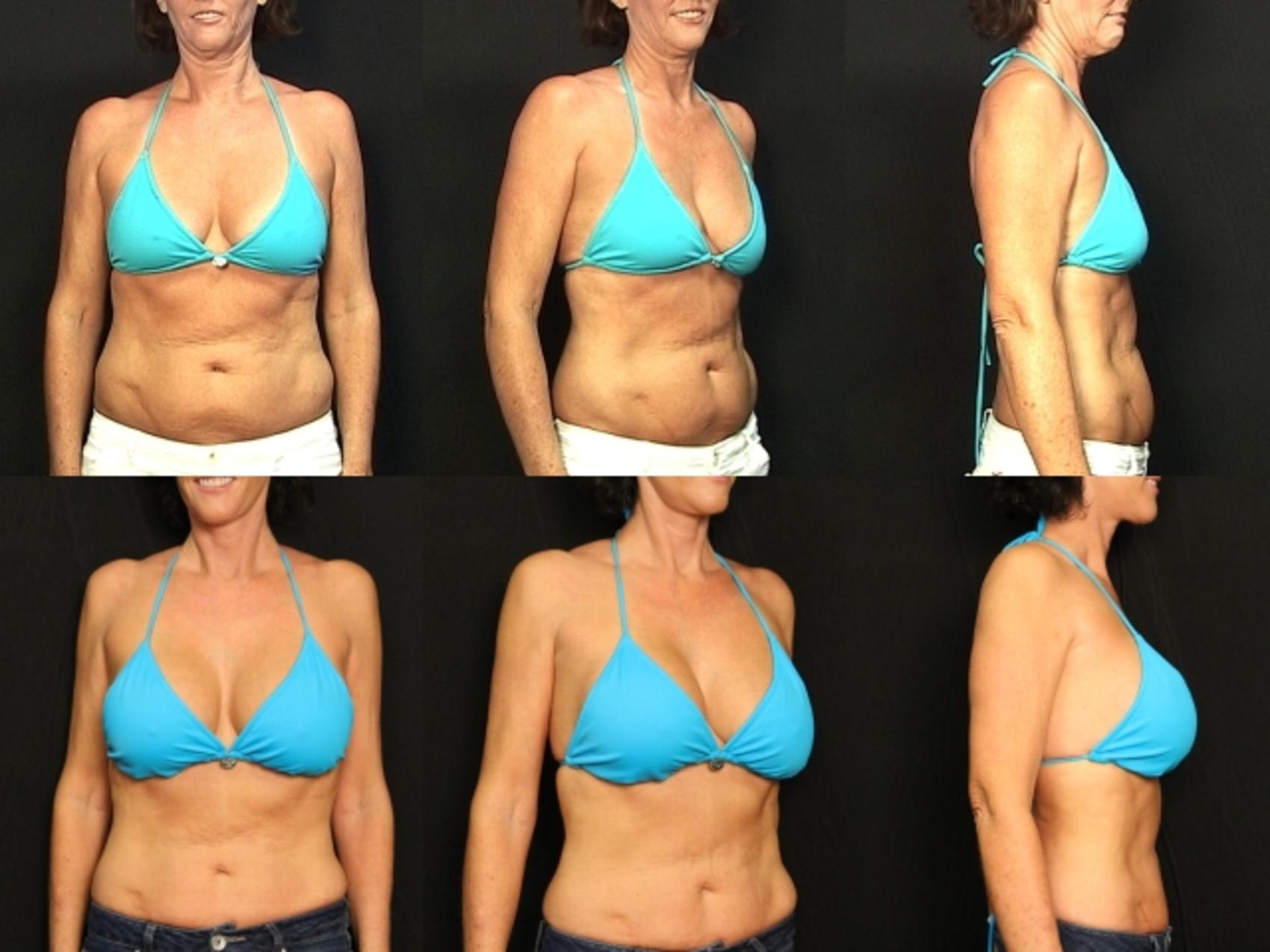 Before & After Breast Augmentation Case 294 View #2 View in Destin & Pensacola, Florida