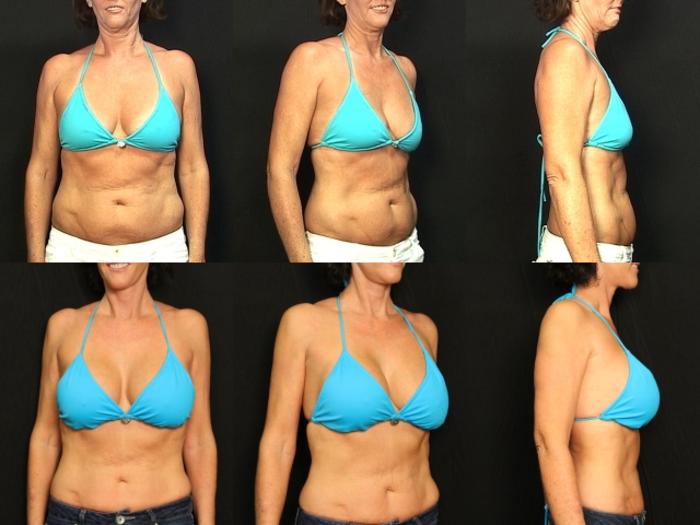 Before & After Breast Augmentation Case 294 View #2 View in Panama City & Pensacola, Florida