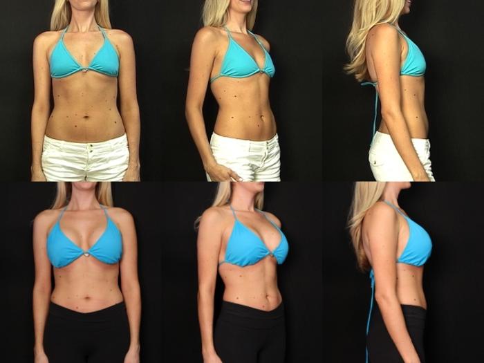 Before & After Breast Augmentation Case 301 View #2 View in Panama City & Pensacola, Florida