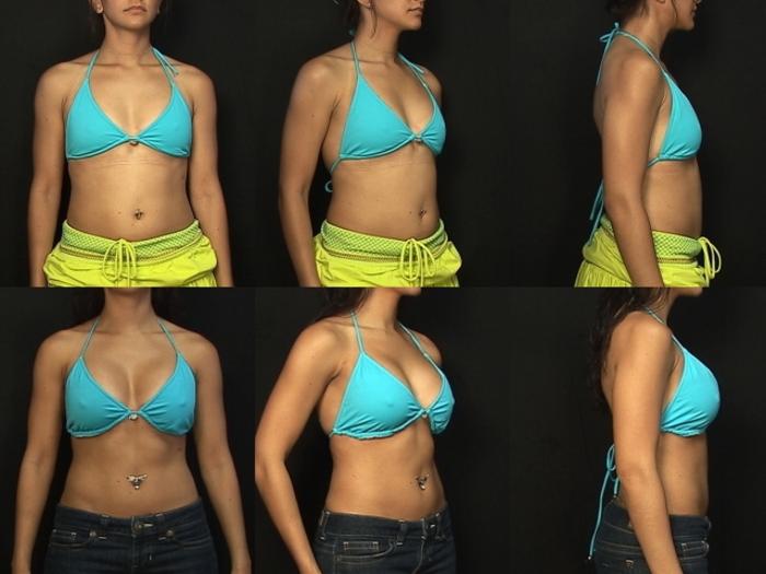 Before & After Breast Augmentation Case 319 View #2 View in Panama City & Pensacola, Florida