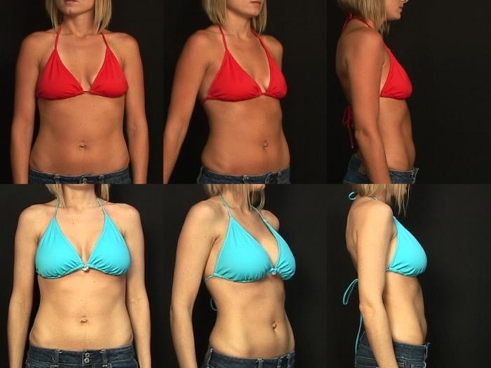 Before & After Breast Augmentation Case 320 View #2 View in Panama City & Pensacola, Florida