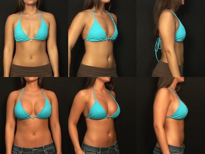 Before & After Breast Augmentation Case 331 View #2 View in Panama City & Pensacola, Florida