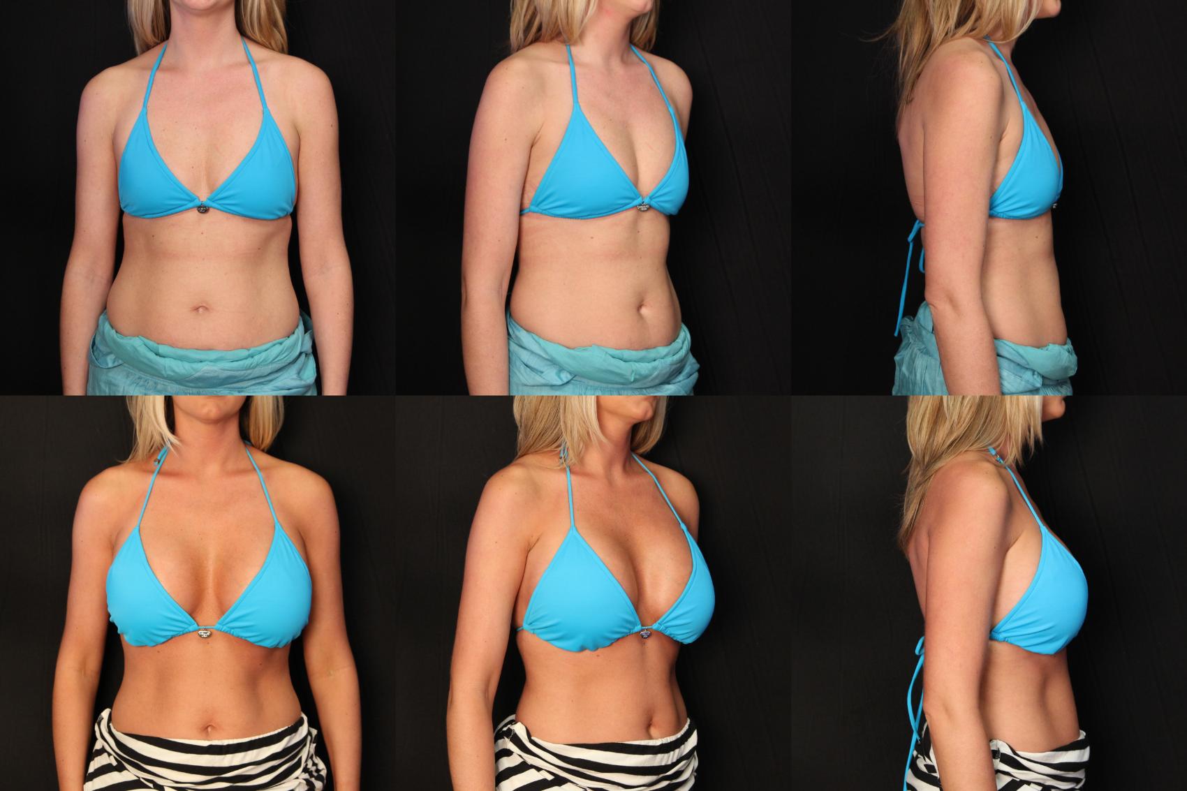 Before & After Breast Augmentation Case 375 View #2 View in Destin & Pensacola, Florida