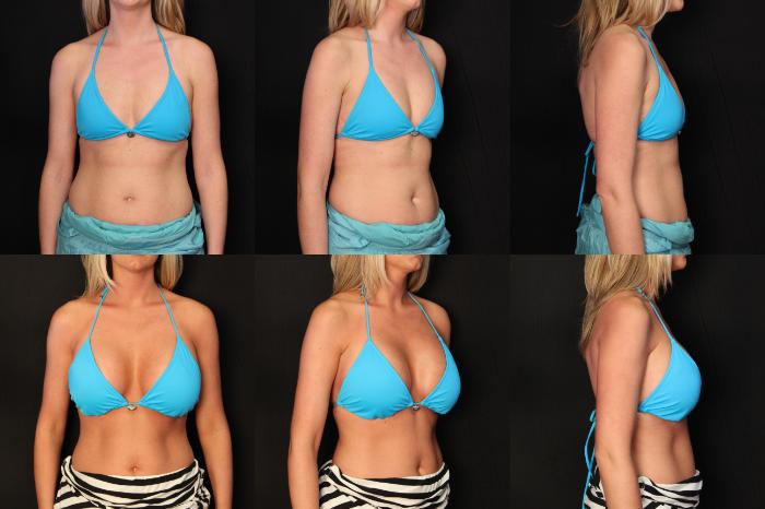 Before & After Breast Augmentation Case 375 View #2 View in Panama City & Pensacola, Florida