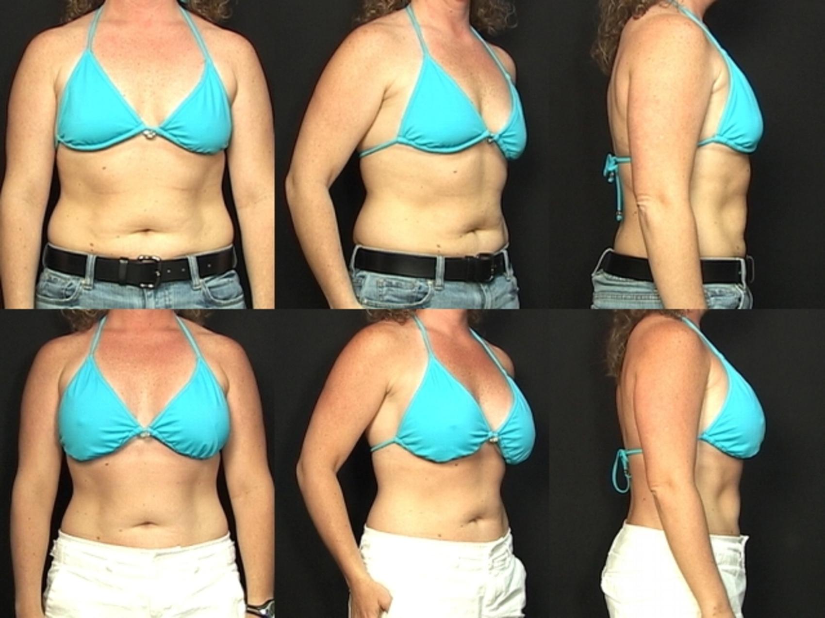 Before & After Breast Augmentation Case 379 View #2 View in Destin & Pensacola, Florida