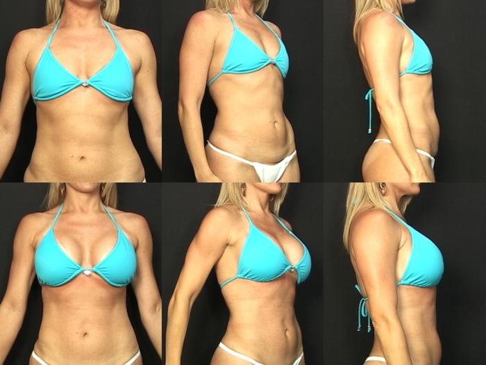 Before & After Breast Augmentation Case 381 View #2 View in Panama City & Pensacola, Florida