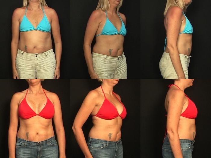 Before & After Breast Augmentation Case 386 View #2 View in Panama City & Pensacola, Florida