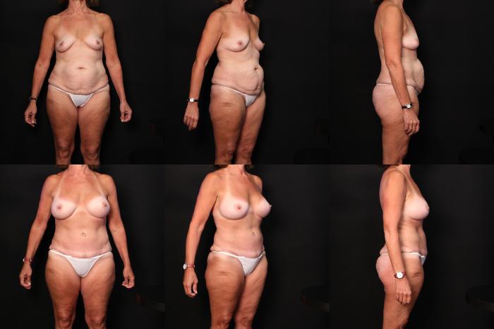 Before & After Breast Augmentation Case 392 View #1 View in Panama City & Pensacola, Florida