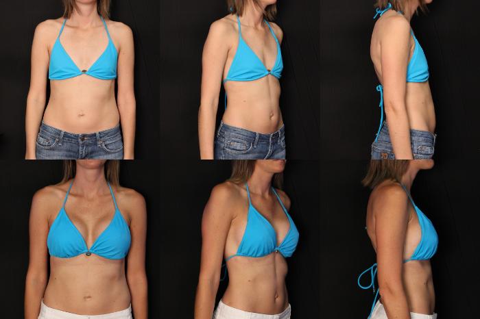 Before & After Breast Augmentation Case 411 View #2 View in Panama City & Pensacola, Florida