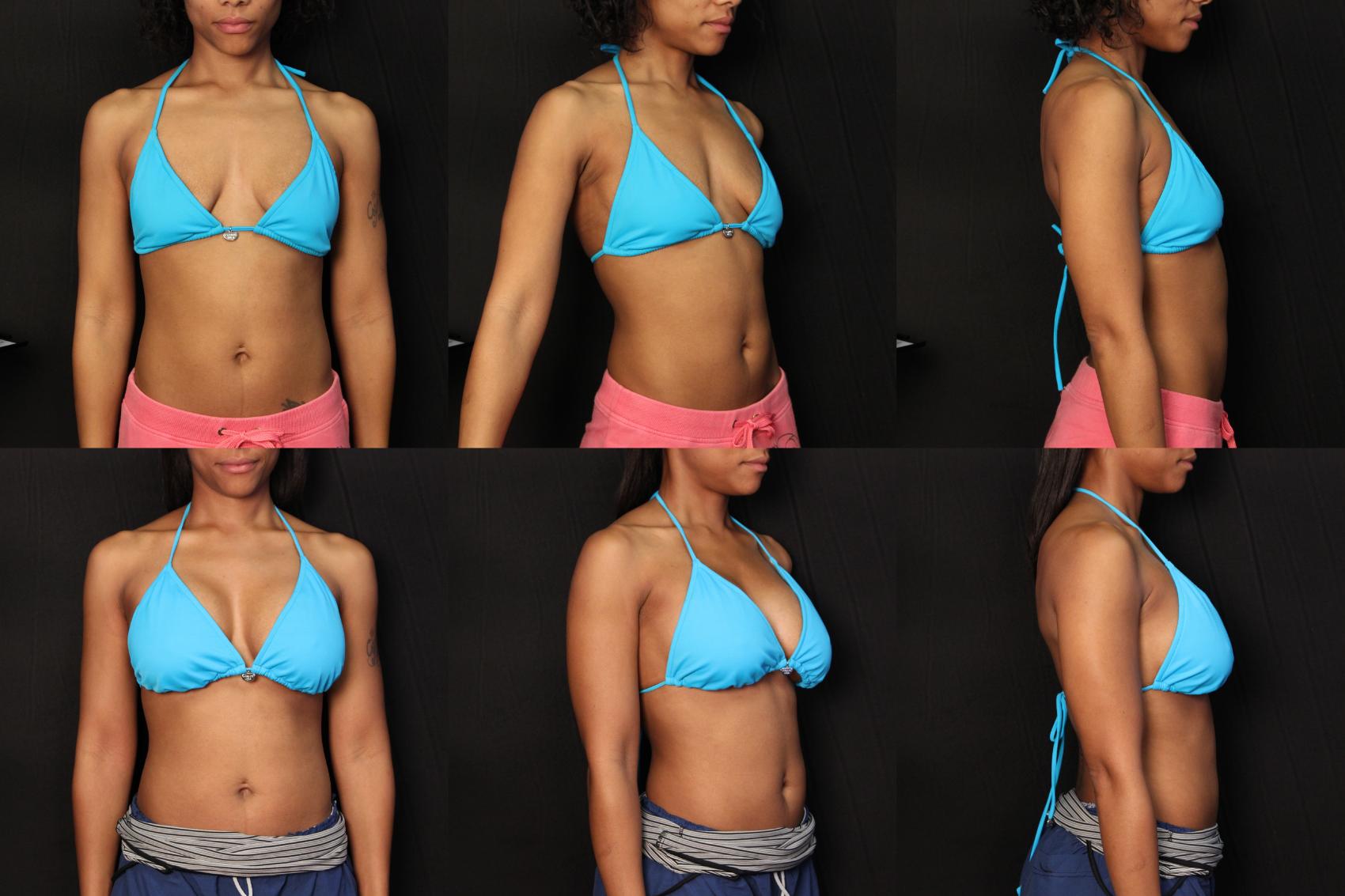 Before & After Breast Augmentation Case 412 View #2 View in Destin & Pensacola, Florida
