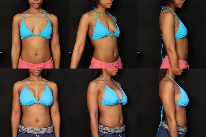 Before & After Breast Augmentation Case 412 View #2 View in Panama City & Pensacola, Florida