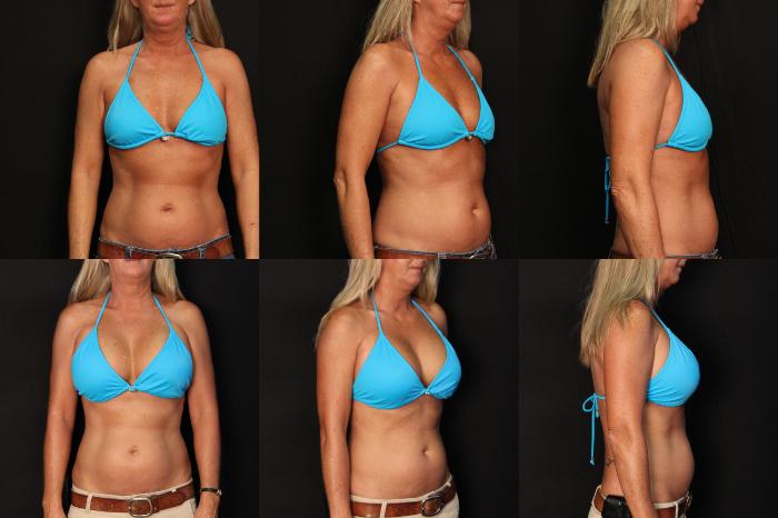 Before & After Breast Augmentation Case 414 View #2 View in Panama City & Pensacola, Florida