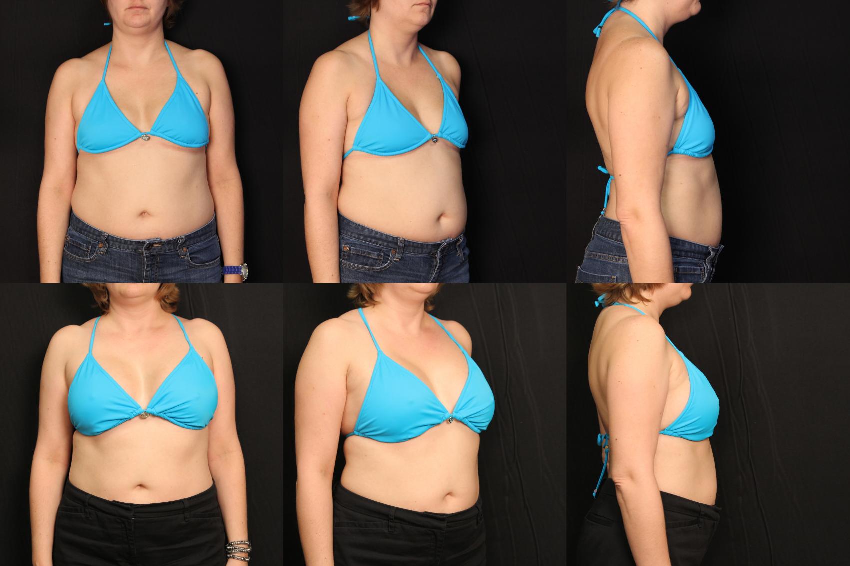 Before & After Breast Augmentation Case 437 View #2 View in Destin & Pensacola, Florida