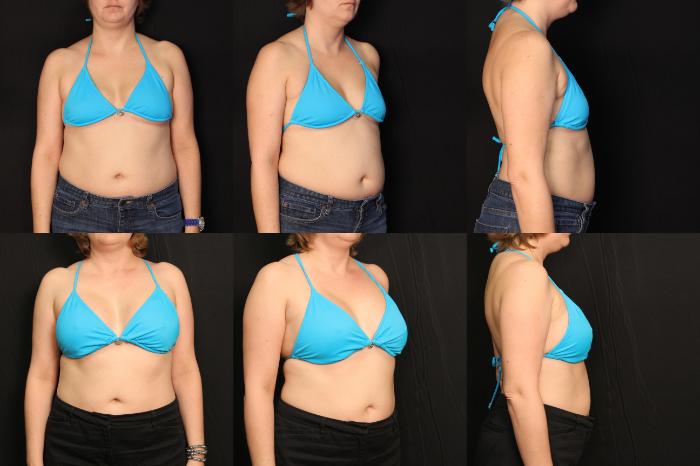 Before & After Breast Augmentation Case 437 View #2 View in Panama City & Pensacola, Florida
