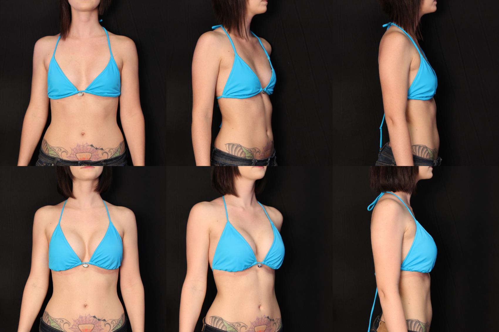 Before & After Breast Augmentation Case 447 View #2 View in Destin & Pensacola, Florida