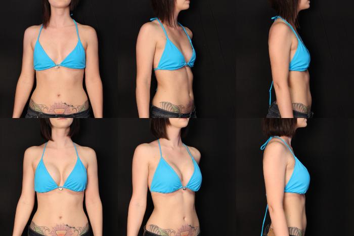 Before & After Breast Augmentation Case 447 View #2 View in Panama City & Pensacola, Florida