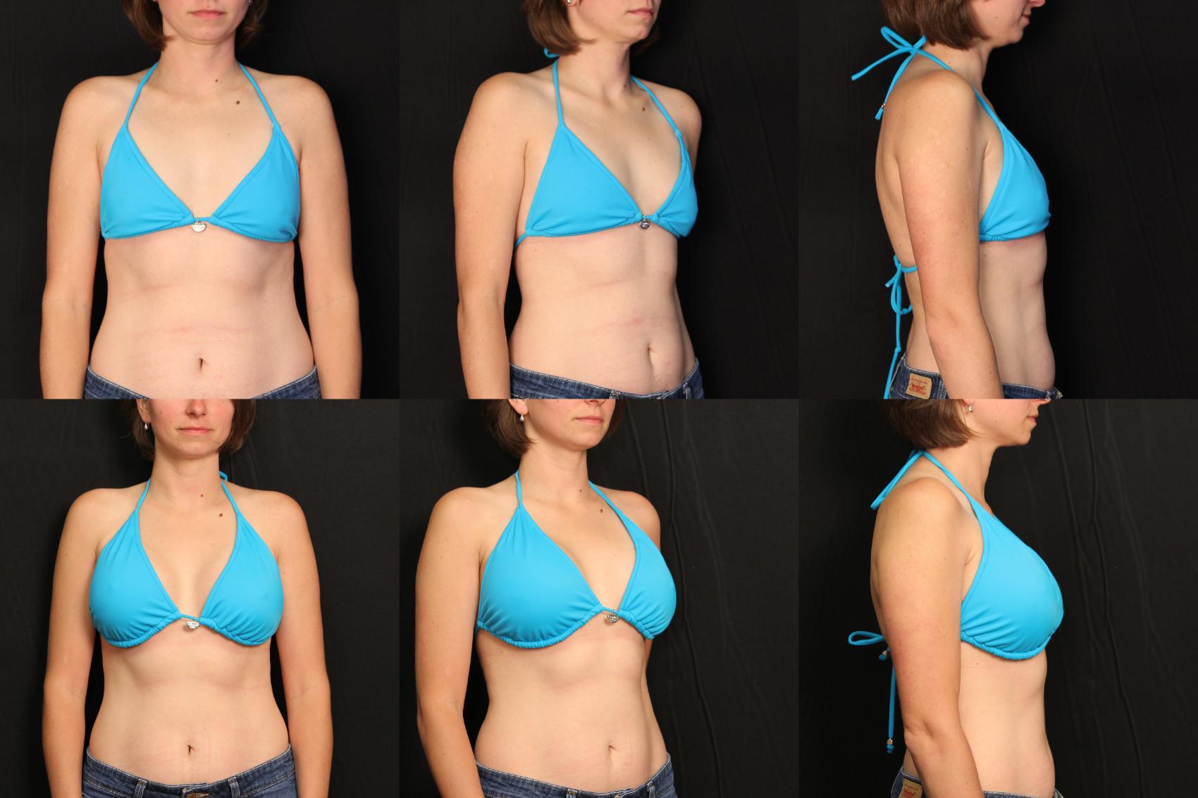 Before & After Breast Augmentation Case 448 View #2 View in Destin & Pensacola, Florida