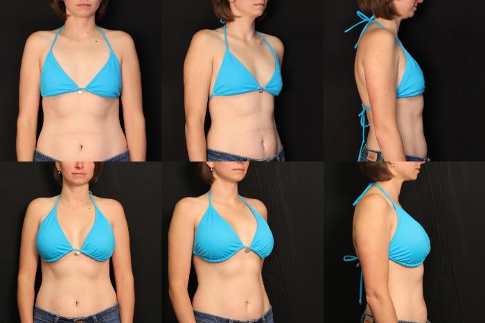Before & After Breast Augmentation Case 448 View #2 View in Panama City & Pensacola, Florida