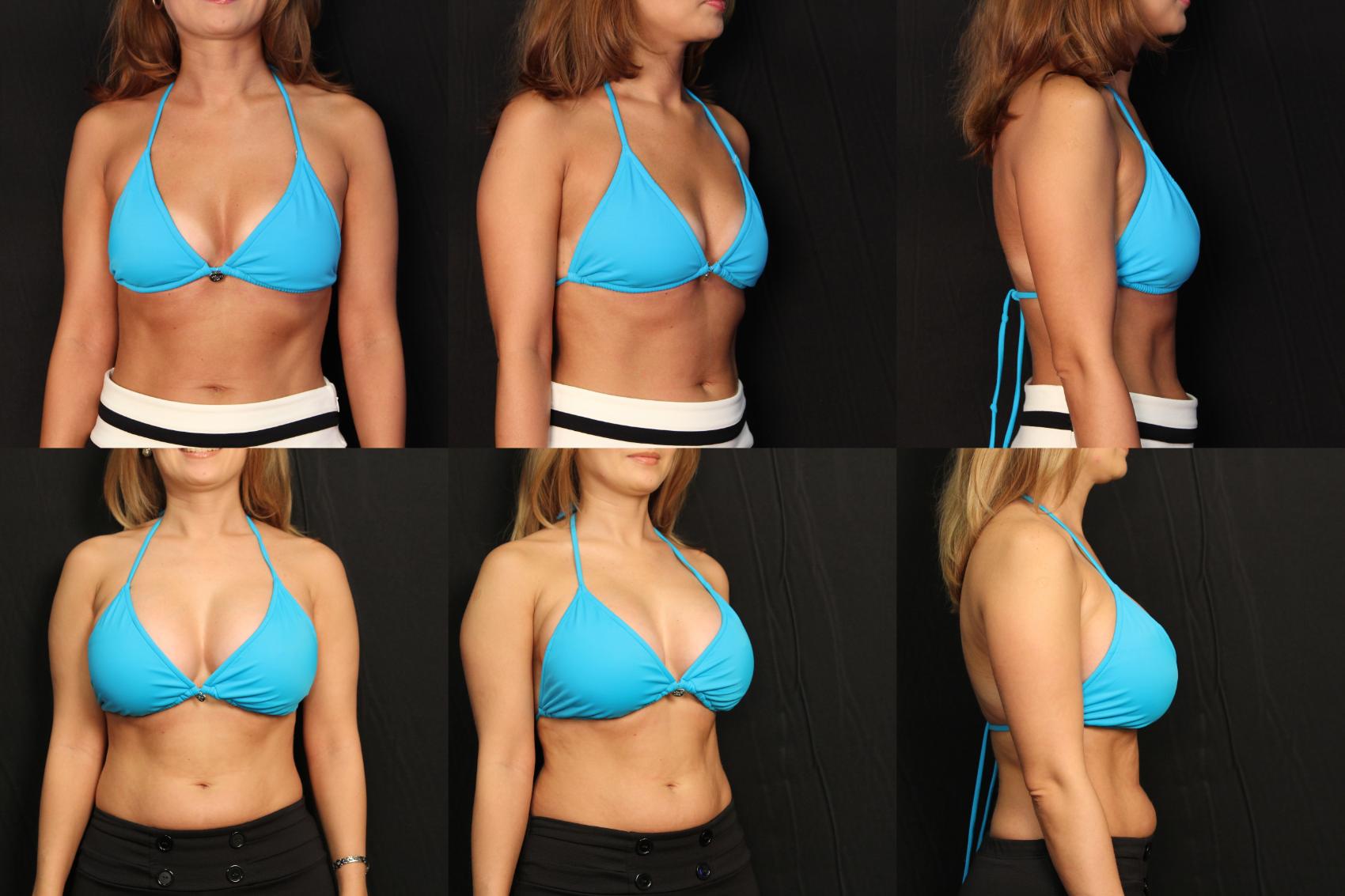 Before & After Breast Augmentation Case 451 View #2 View in Destin & Pensacola, Florida
