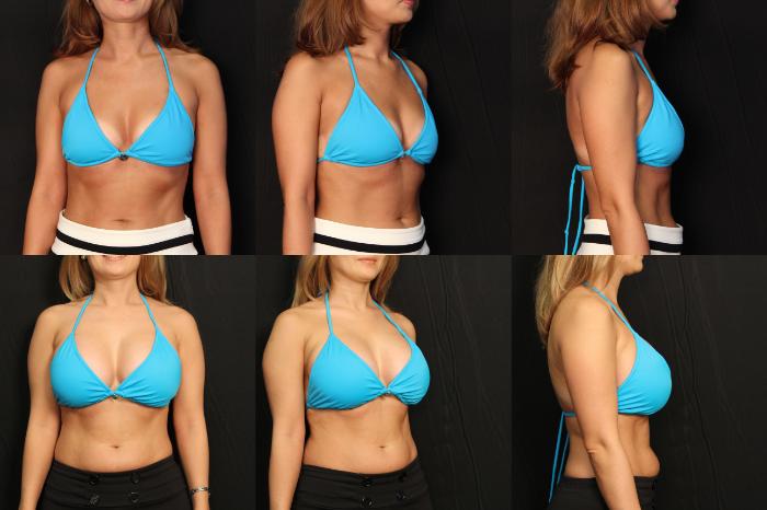 Before & After Breast Augmentation Case 451 View #2 View in Panama City & Pensacola, Florida