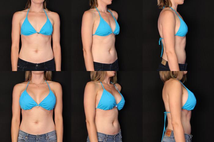 Before & After Breast Augmentation Case 452 View #2 View in Panama City & Pensacola, Florida