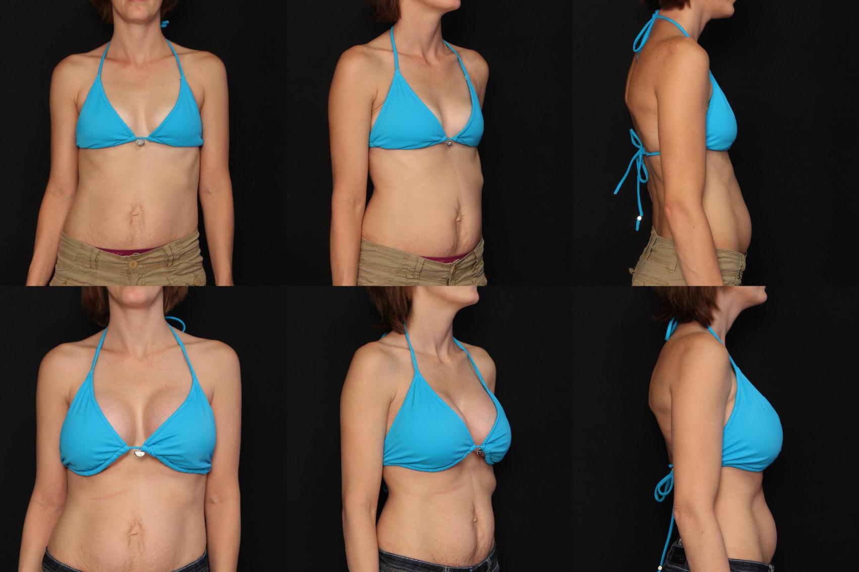 Before & After Breast Augmentation Case 475 View #2 View in Destin & Pensacola, Florida
