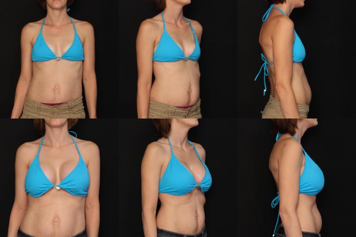 Before & After Breast Augmentation Case 475 View #2 View in Panama City & Pensacola, Florida